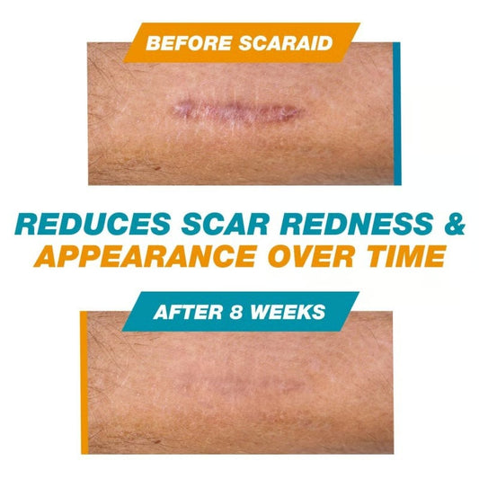 Skin Scar Solutions?️ 60% Silicone Scar Stick. - spiiyle